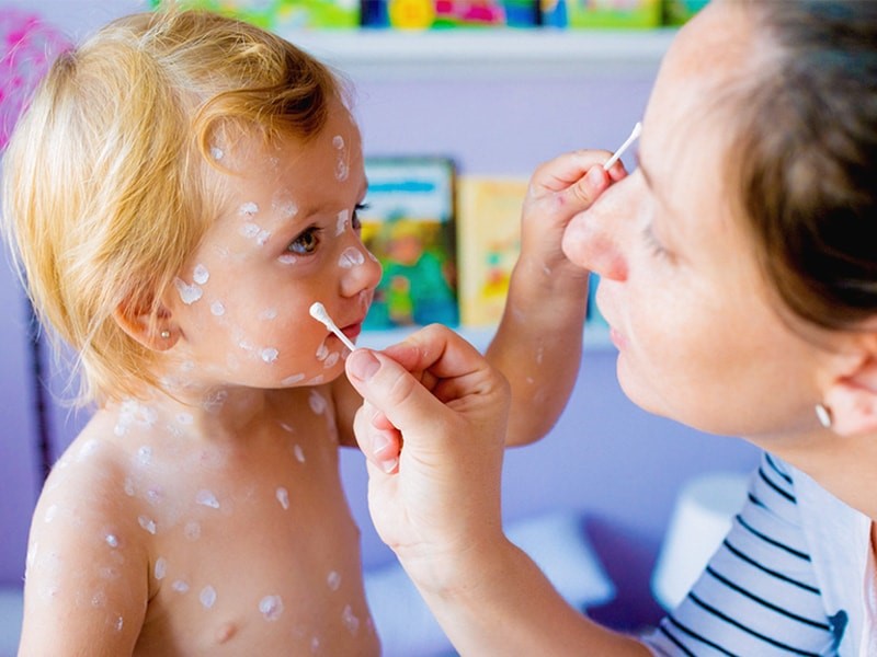 درمان آبله مرغان کودکان