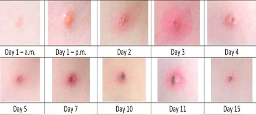 عکس آبله مرغان در روزهای اول