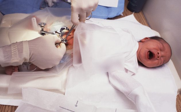ختنه نوزاد با دستگاه کلیپس نقره ای