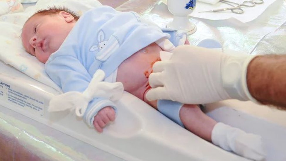 ختنه نوزادا به روش جراحی