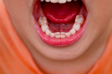 دوره دندانی مختلط در کودکان