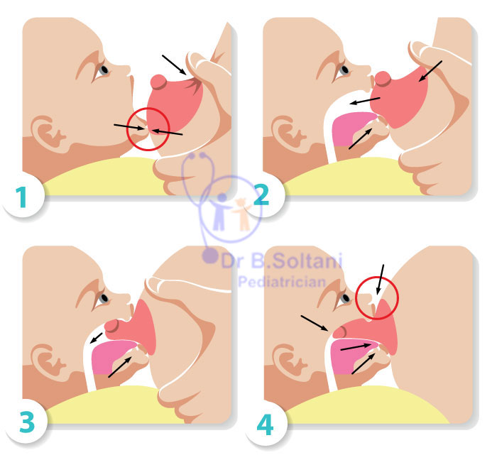 روش صحیح قرار دادن نوک سینه در دهان نوزاد در هنگام شیردهی